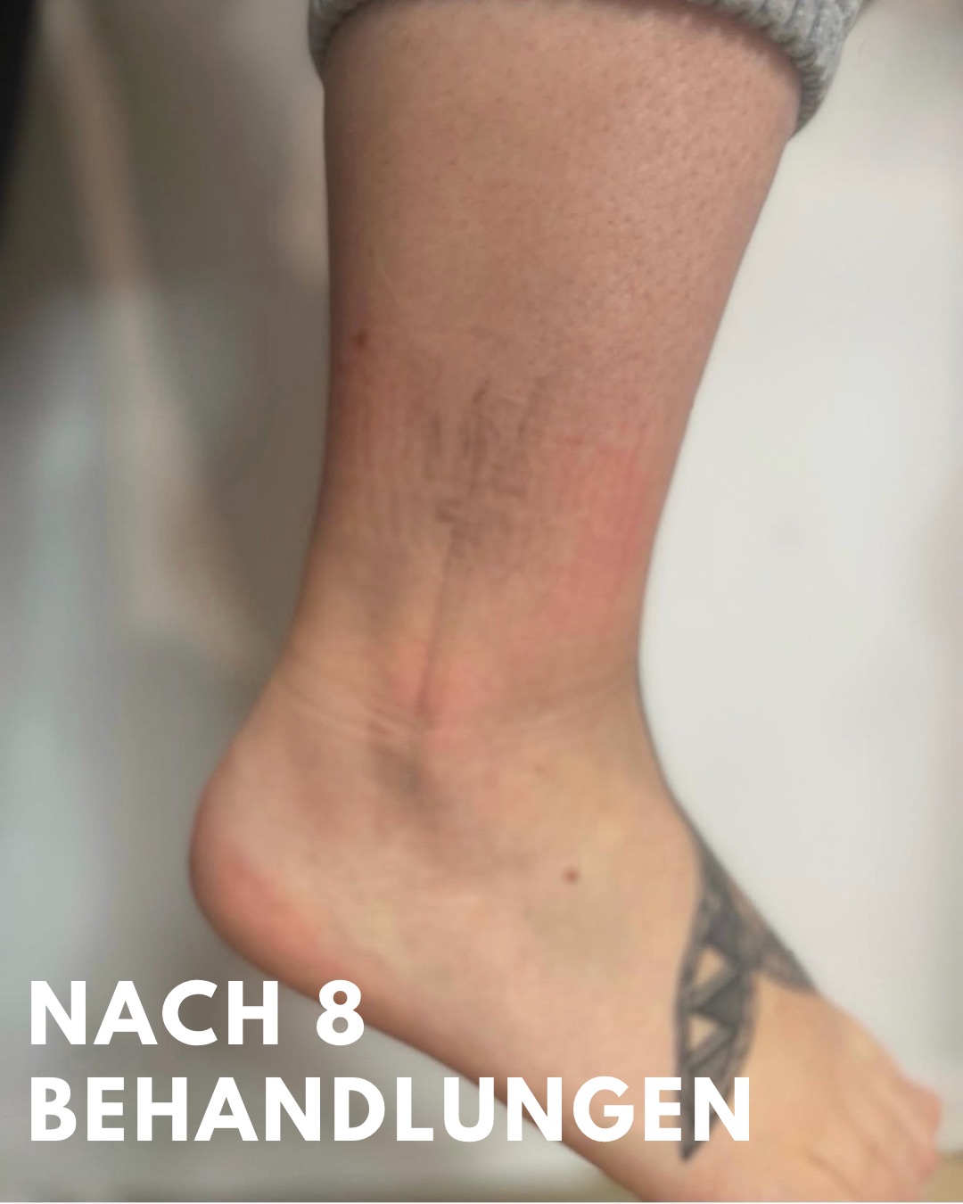 Nachher – Bein